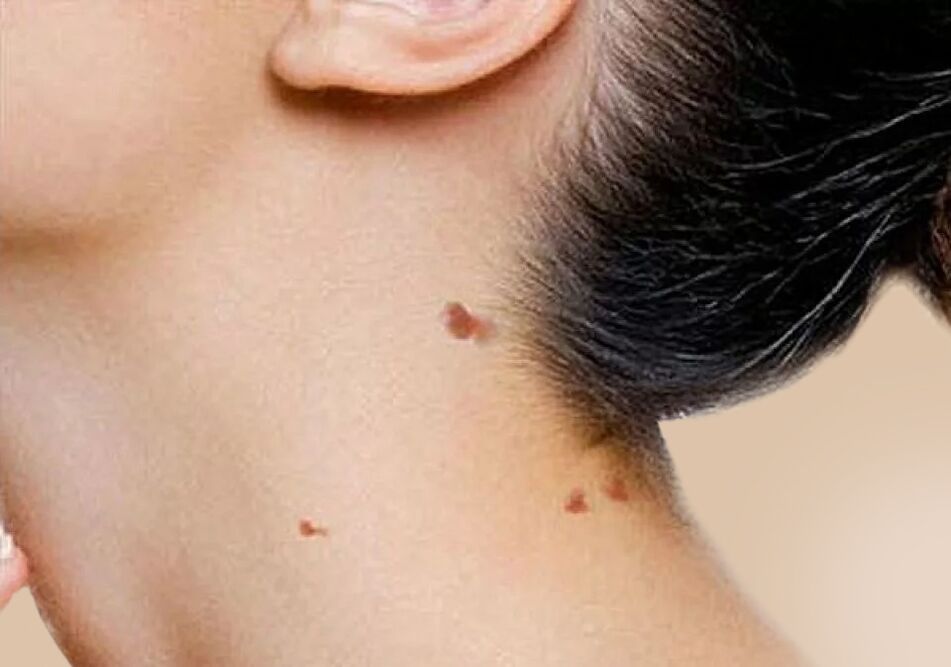 La comparsa di papillomi sul collo dopo l'attivazione dell'HPV nel corpo