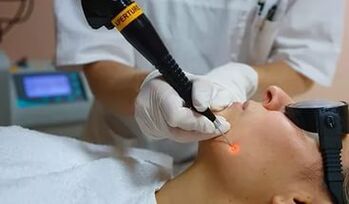 Una procedura efficace per rimuovere il papilloma sul viso con un laser