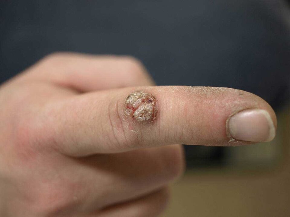 Grande verruca su un dito che richiede la rimozione