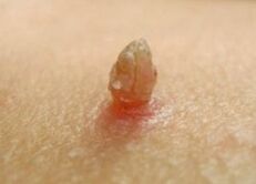 Papilloma acuto