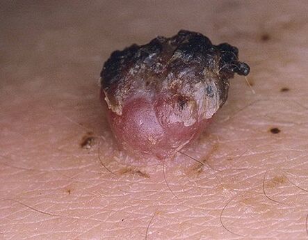 Papilloma annerito