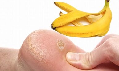 Buccia di banana per il trattamento di una verruca plantare