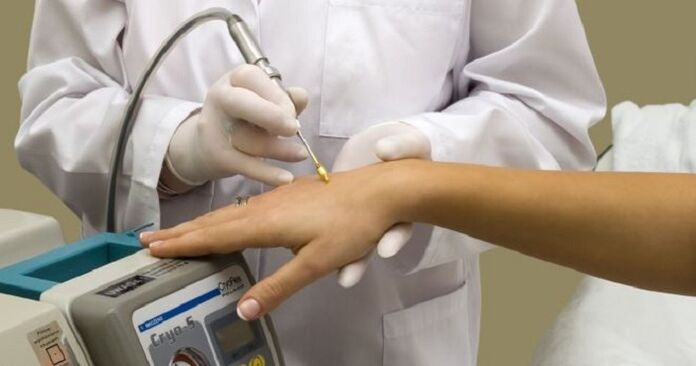 cauterizzazione con azoto liquido