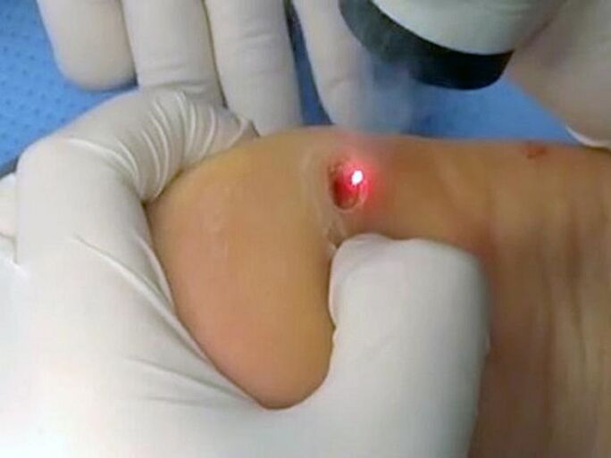 trattamento laser per le verruche