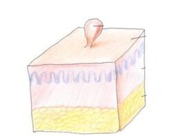 come sbarazzarsi del papilloma sul corpo