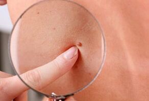 ragioni per la comparsa di papillomi sul corpo umano