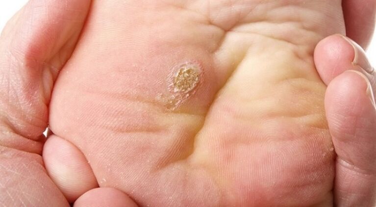 papillomi plantari e piatti