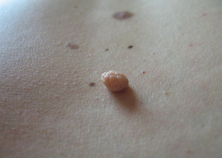papillomi sul corpo umano