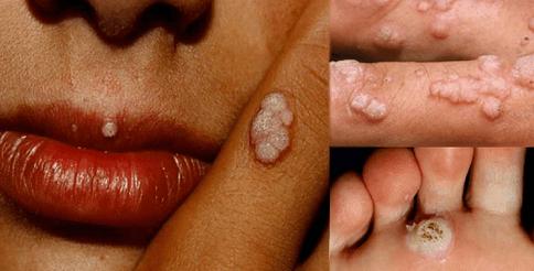 papillomi in tutto il corpo