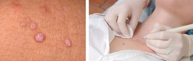 rimozione professionale di papillomi sul corpo