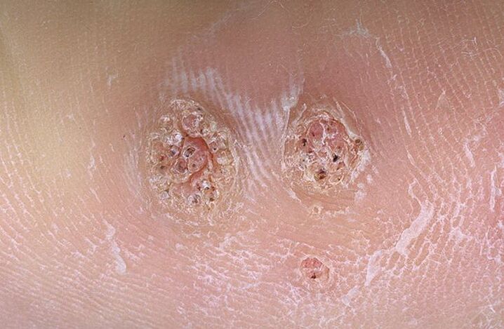 verruche sul corpo