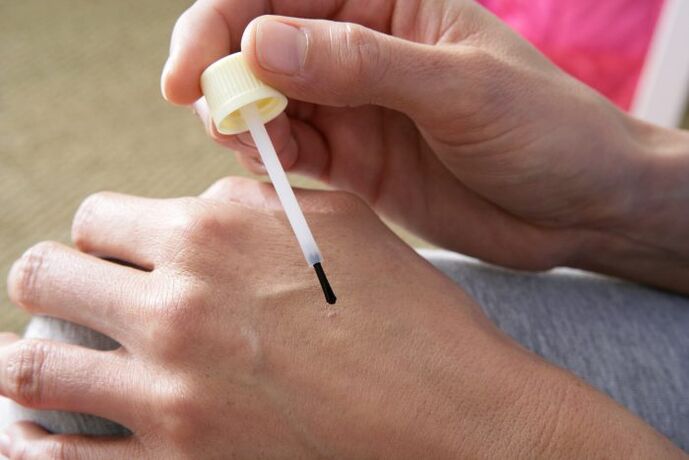 cauterizzazione delle verruche con succo di celidonia